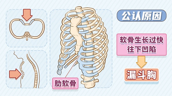 漏斗胸严重分类图图片