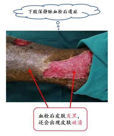 腿部树胶样肿真实图片图片